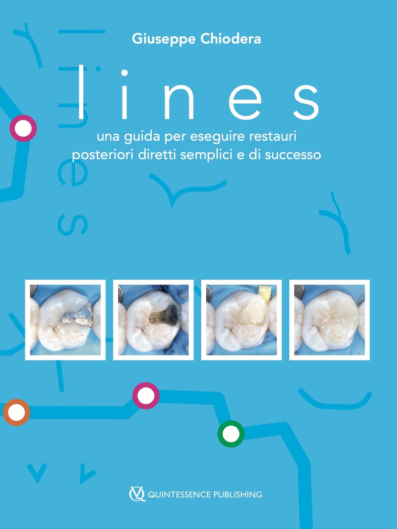 Libri Chiudera Giuseppe - Lines. Una Guida Per Eseguire Restauri Posteriori Diretti Semplici E Di Successo NUOVO SIGILLATO EDIZIONE DEL SUBITO DISPONIBILE