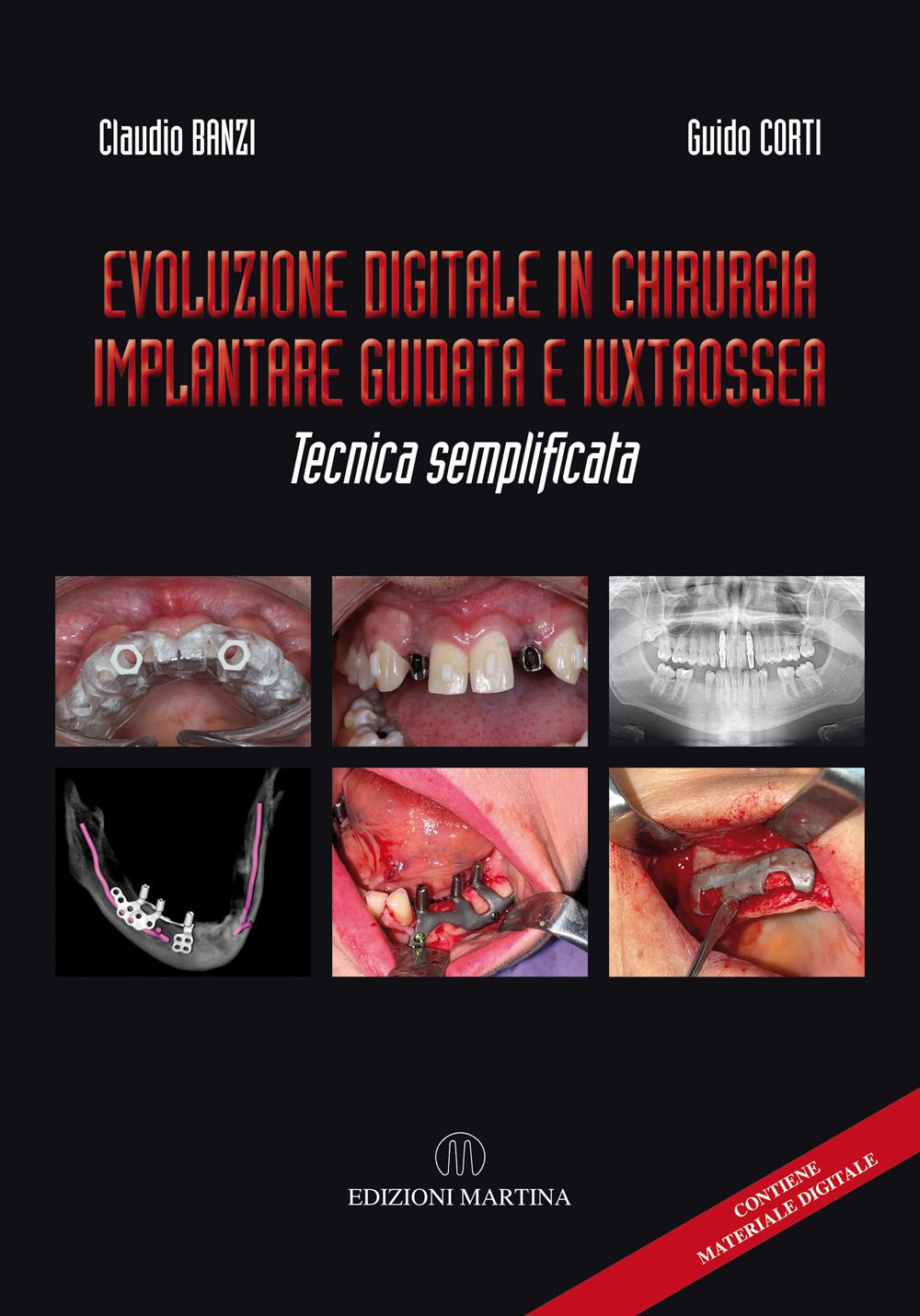 Libri Banzi Claudio Guido Corti - Evoluzione Digitale In Chirurgia Implantare Guidata E Iuxtaossea. Tecnica Semplificata. Ediz. Italiana E Inglese. Con QR NUOVO SIGILLATO EDIZIONE DEL SUBITO DISPONIBILE