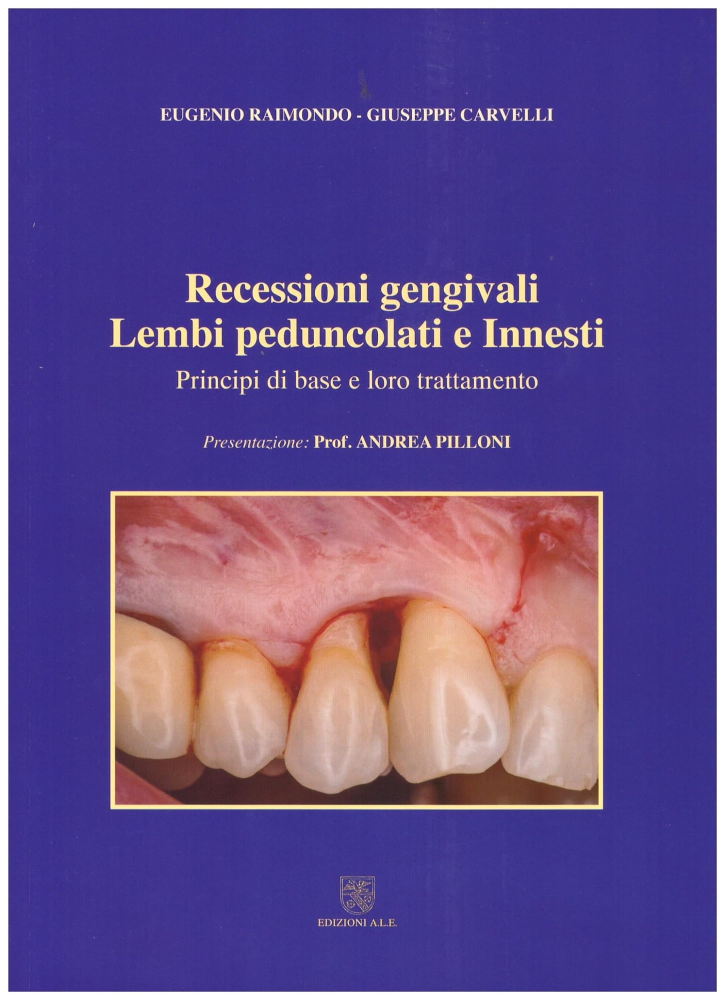 Libri Raimondo Eugenio Carvelli Giuseppe - Recessioni Gengivali. Lembi Peduncolati E Innesti. Principi Di Base E Loro Trattamento NUOVO SIGILLATO SUBITO DISPONIBILE